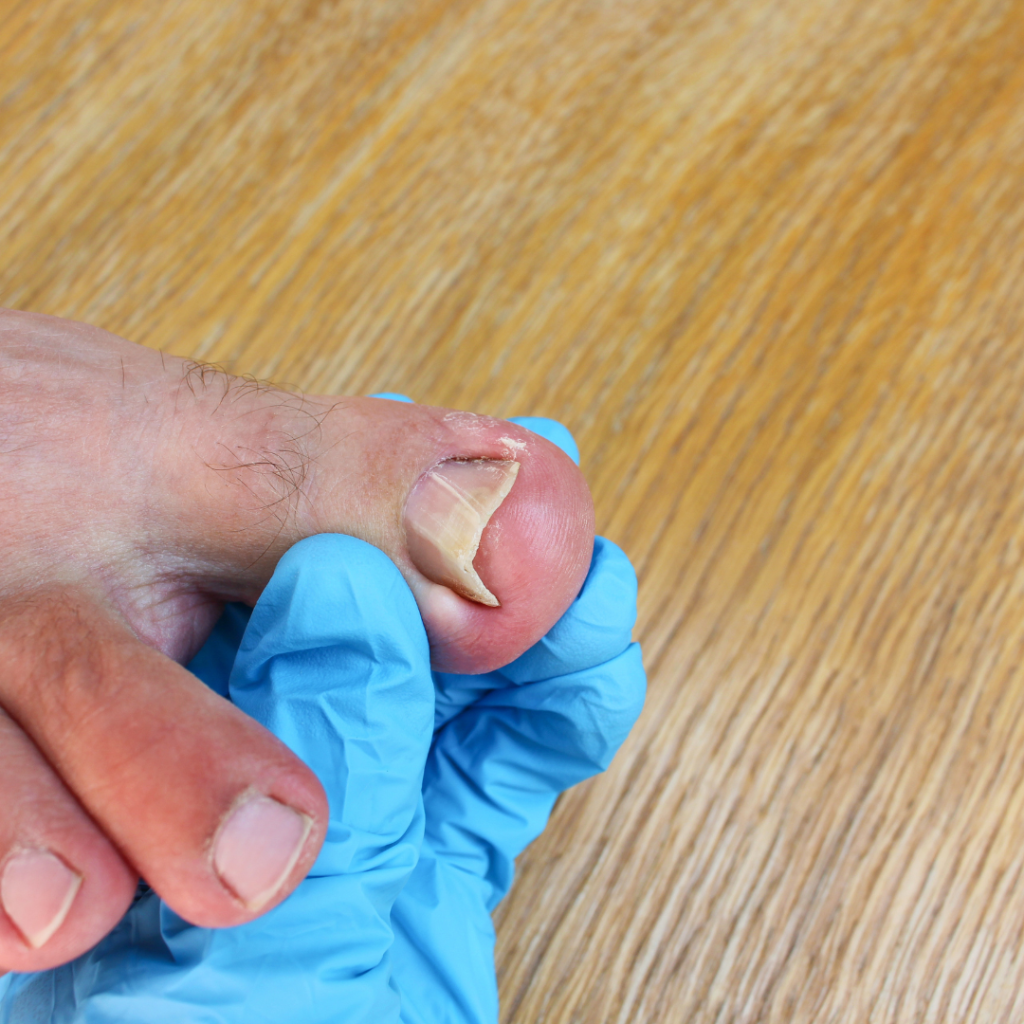 Relief from ingrown toe nail pain. Treatment by experienced podiatrist in Sydney